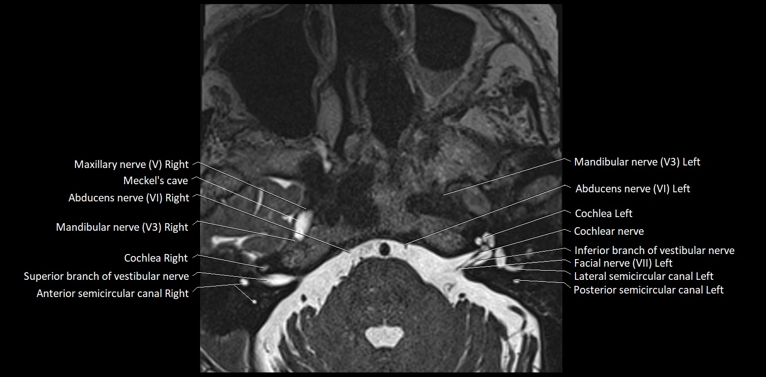 Cranial nerve anatomy axial MRI 3T image 51.webp